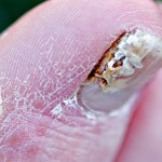 Nail Fungus