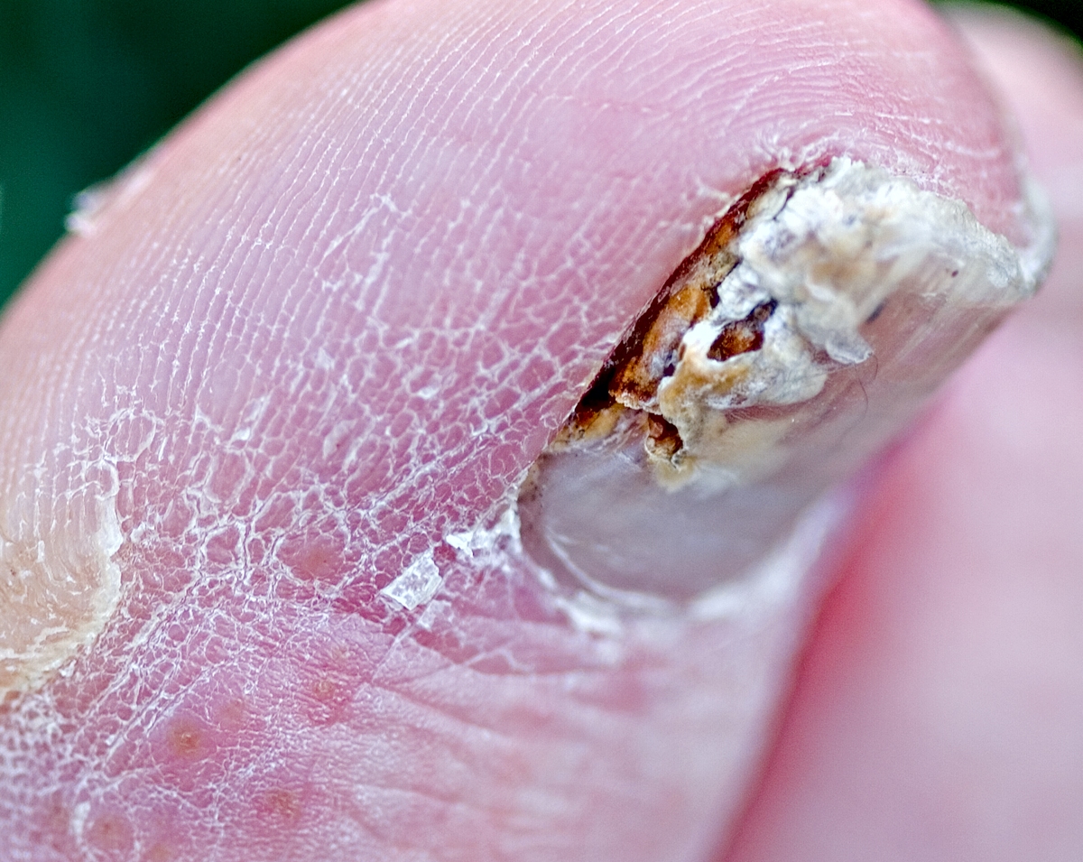 Nail Fungus