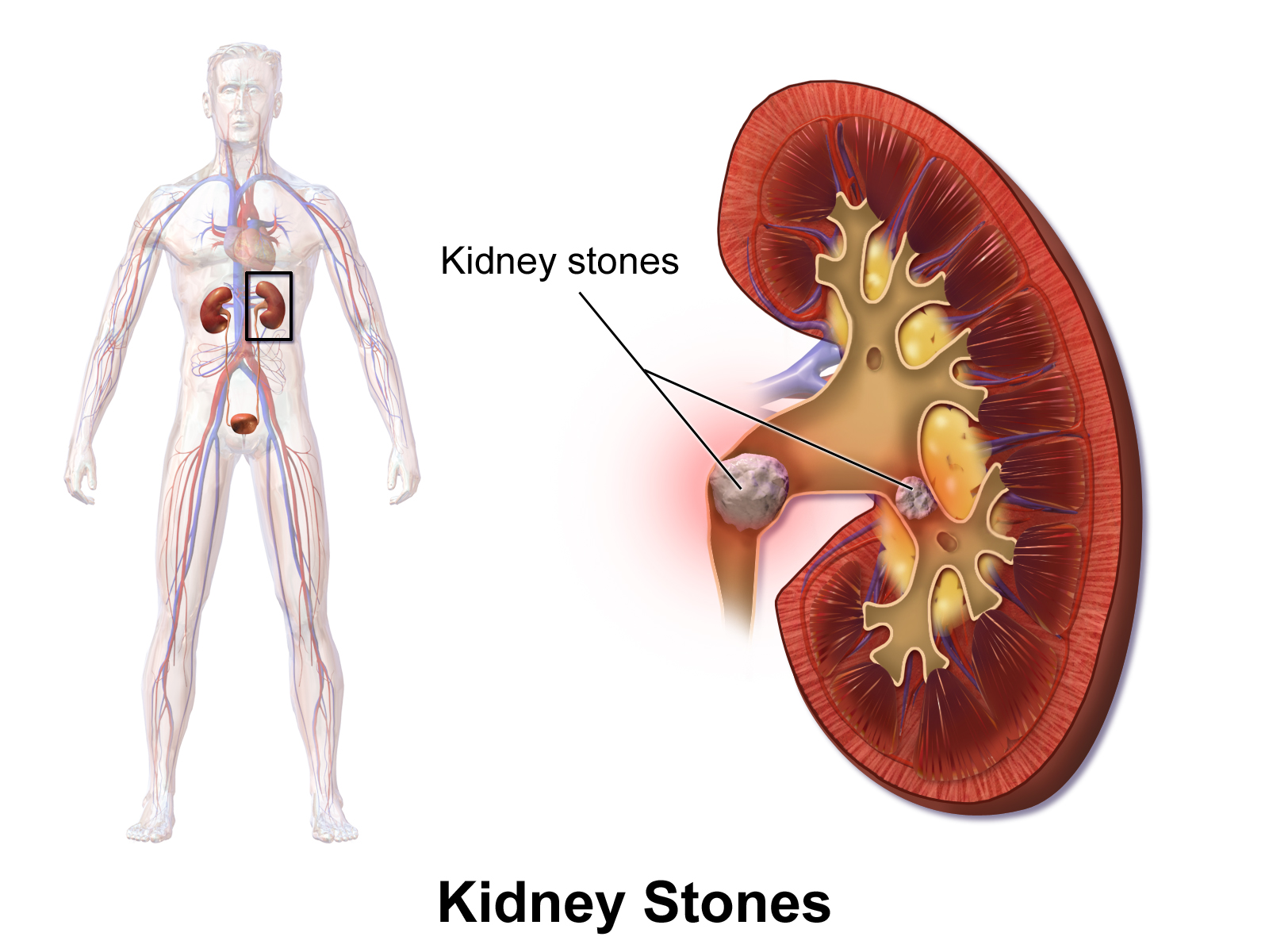 Kidney Stones 01