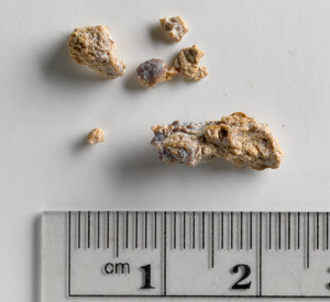 Kidney Stones 02