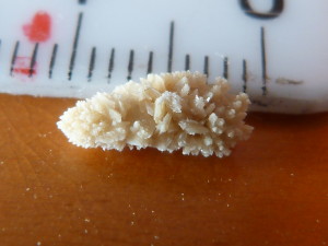 Kidney Stones 03