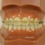 braces model