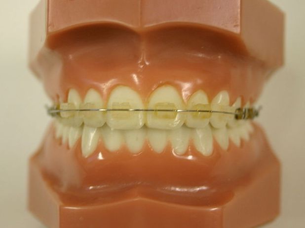 braces model