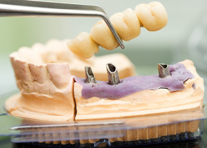 denture