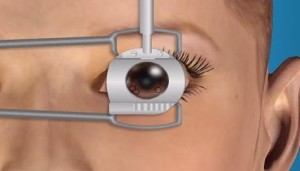Corrective Eye Surgery