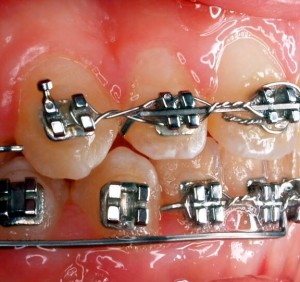 Braces